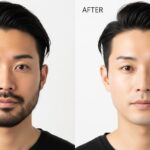 髭脱毛 肌綺麗になる